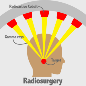 radiosurgery