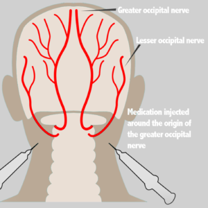 occipital nerve block