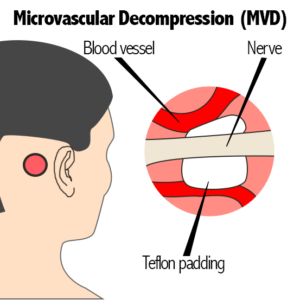 Microvascular Decompression