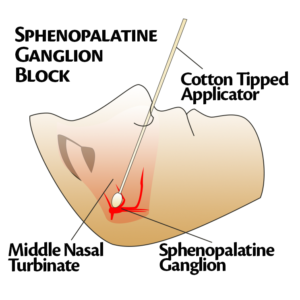 sphenopalatine ganglion