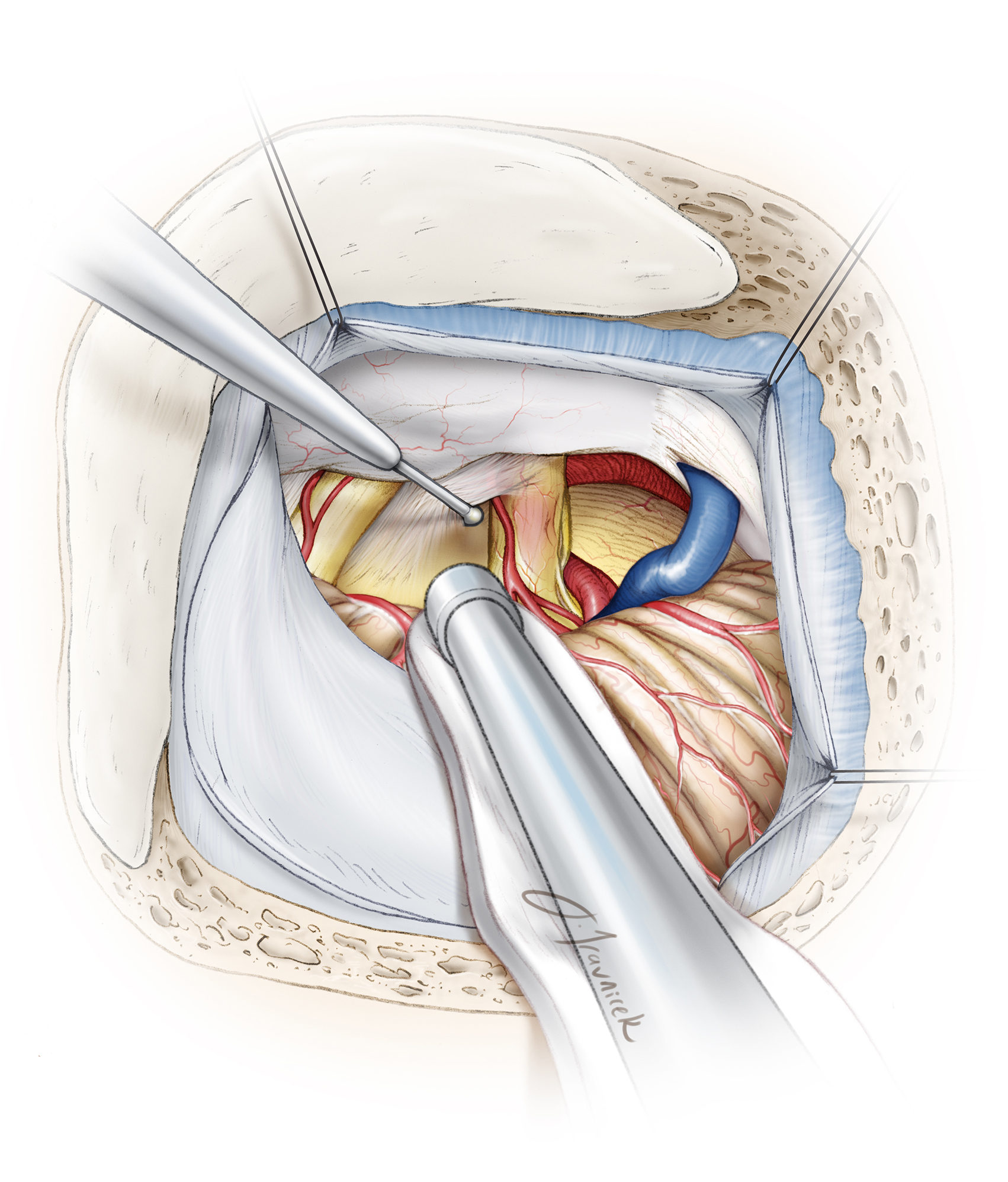 Treatment Option: Microvascular Decompression Surgery - Face Facts